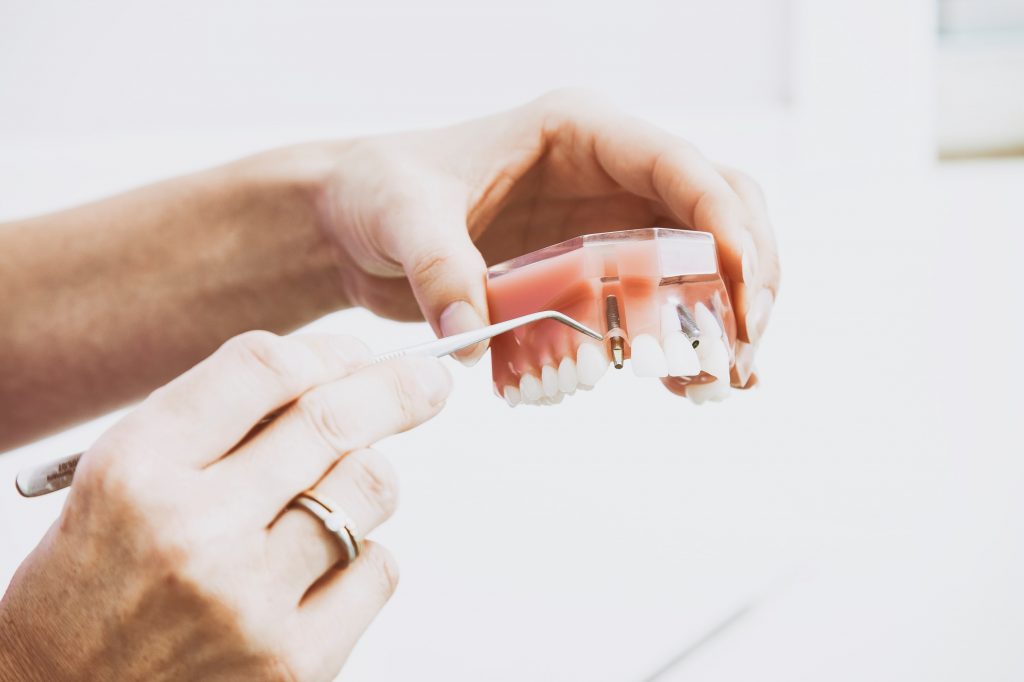Affordable Dental Implants in Perth